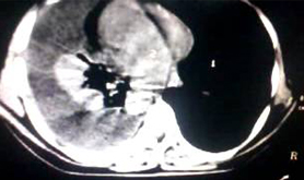 CT Chest Pain